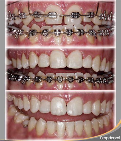 metal en el paladar brackets|brackets metalicos antes y después.